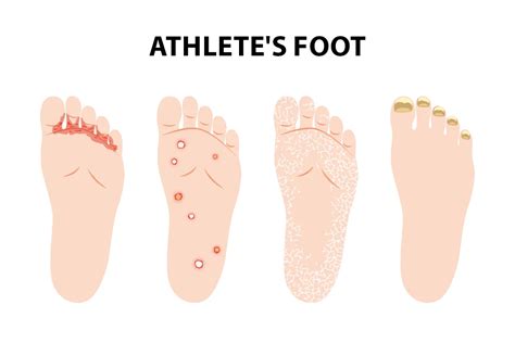 Illustration showing the typical appearance of athlete's foot, jock itch, and ringworm.