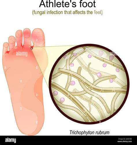 Diagram illustrating the spread of fungal infections like athlete's foot and ringworm.