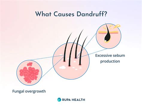Infographic explaining the causes of dandruff: yeast, oil production, and immune response