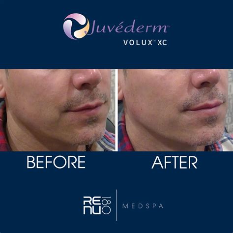 Infographic illustrating the structure of hyaluronic acid molecules in Juvéderm Volux® XC and their cohesive properties for jawline sculpting.