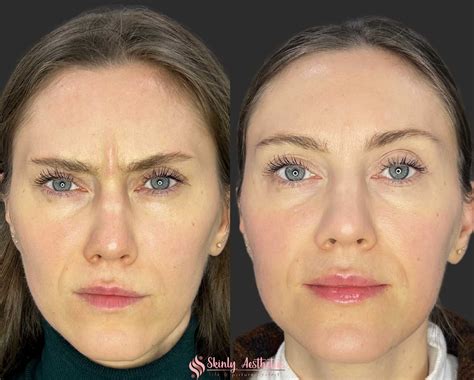 Split image: Left side shows a before photo of frown lines, right side shows after photo with visibly reduced lines after Botox treatment.