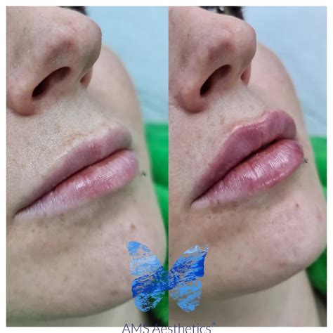 Side-by-side comparison of lip filler results: one showing subtle enhancement for thin lips, another showing definition improvement for fuller lips.