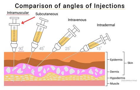 Illustration showing a patient receiving buttock injections with a cannula.