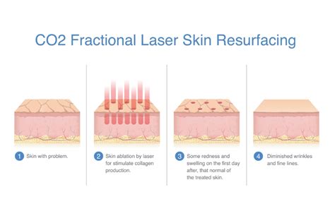 diagram illustrating the layers of skin and the effect of CO2 laser resurfacing