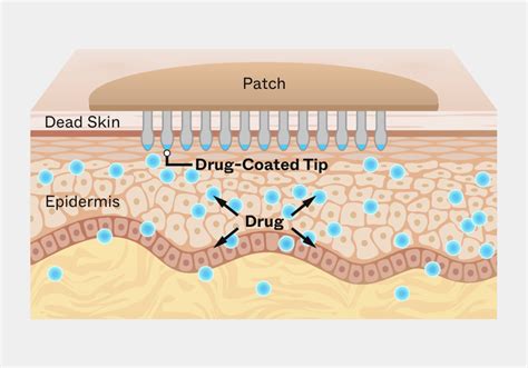 Schematic illustration of a microneedle patch delivering medication to the skin.