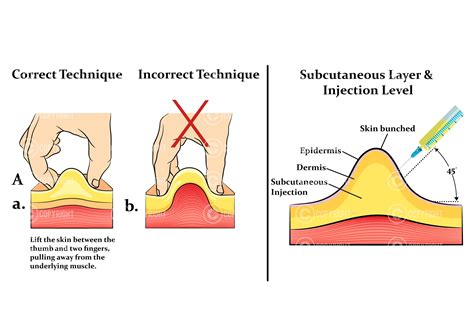 Diagram showing correct subcutaneous injection technique, including site rotation and skin pinching.