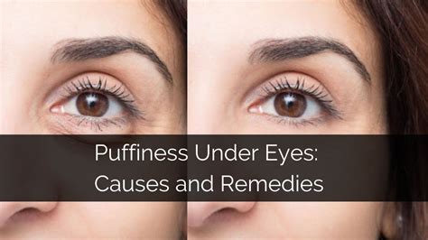 Infographic comparing causes of under-eye puffiness: muscle contraction vs. fat pads.