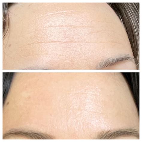 Before and after images showcasing the reduction of fine lines and wrinkles after consistent retinol use.
