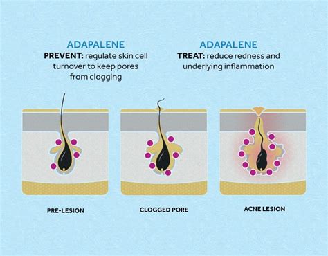 Infographic illustrating the mechanism of adapalene in treating acne by regulating skin cell turnover and preventing pore clogging.