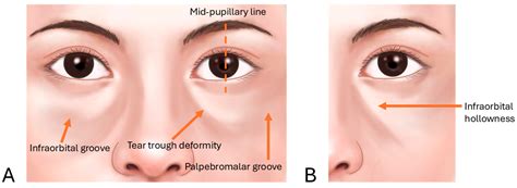 Illustration showing the tear trough area and how volume loss creates hollows and dark circles.
