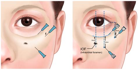 Diagram illustrating the injection technique for tear trough fillers, showing placement above bone and below muscle.