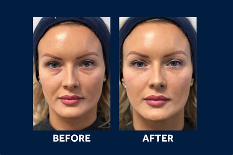 Infographic showing common post-treatment advice for tear trough fillers, including ice packs and avoiding heat.