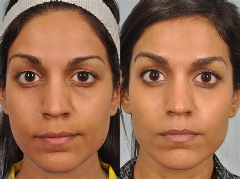 Before and after images showcasing subtle yet effective results of tear trough filler treatment.