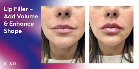 Illustration comparing the effects of lip filler and lip flip on lip volume and shape.