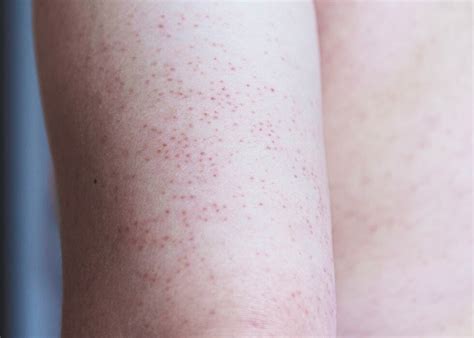 Illustration of a toddler's arm with small, red bumps characteristic of keratosis pilaris.
