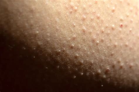 Close-up image showing the texture of skin affected by keratosis pilaris, highlighting the small bumps.