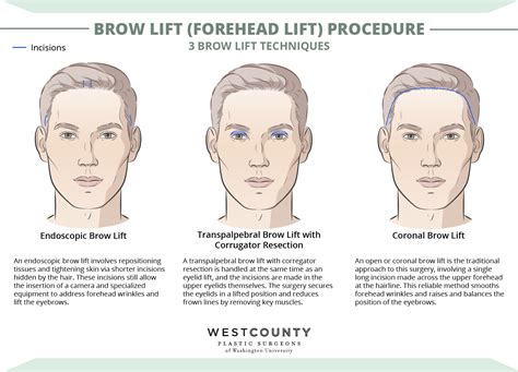 Illustration showing the natural aging process of the brow area and the effect of a brow lift.