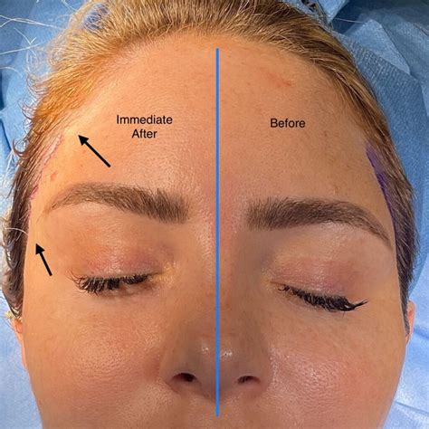 Diagram illustrating the different incision points and tissue manipulation for open, endoscopic, and lateral temporal brow lifts.