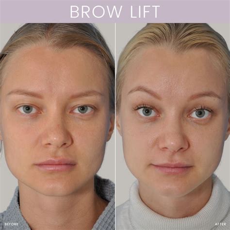 Before and after photos showcasing the results of a brow lift, highlighting improved eyebrow position and reduced forehead lines.