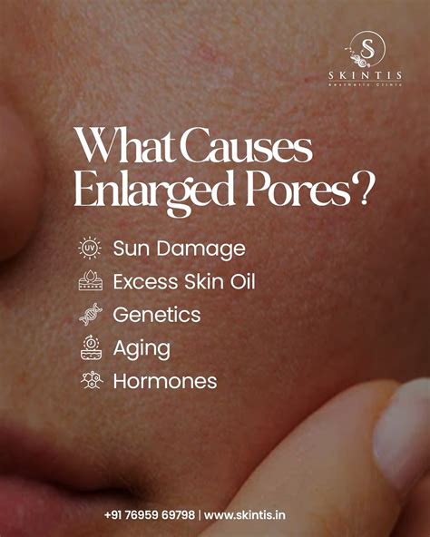 Infographic illustrating the causes of enlarged pores: genetics, aging, hormones, oily skin, sun damage, and acne.
