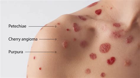 Illustration showing pinpoint red dots on skin, characteristic of petechiae