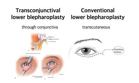 A diagram illustrating the different incision points for upper and lower blepharoplasty, including transconjunctival and external approaches.