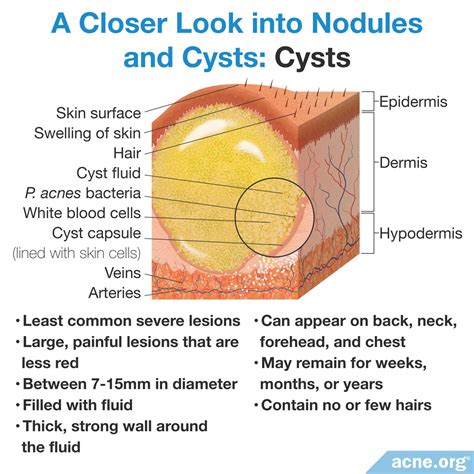 Illustration showing the internal structure of a cystic acne lesion compared to a regular pimple.