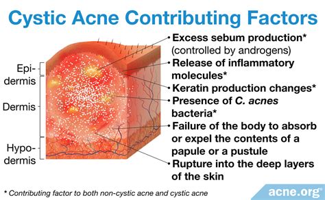 Infographic illustrating the various factors contributing to cystic acne.