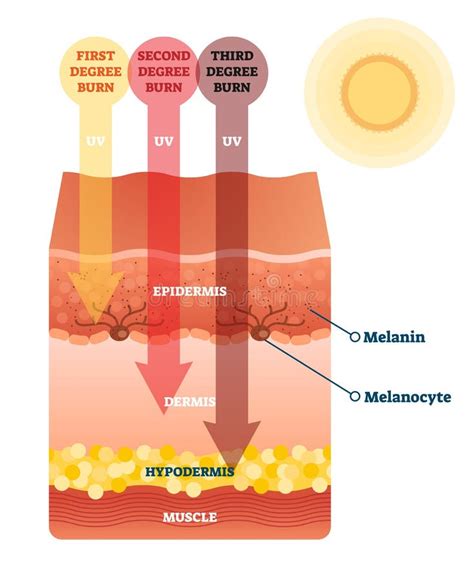 diagram showing the layers of skin affected by sunburn