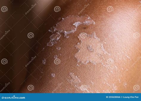 close-up of a cloth soaked in milk being applied to a sunburned arm