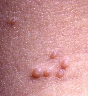 Illustration of molluscum contagiosum bumps with central umbilication