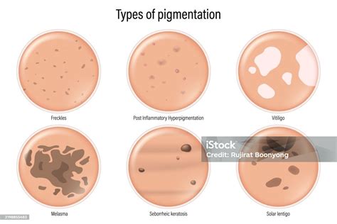 Illustration showing the process of post-inflammatory hyperpigmentation after a pimple.