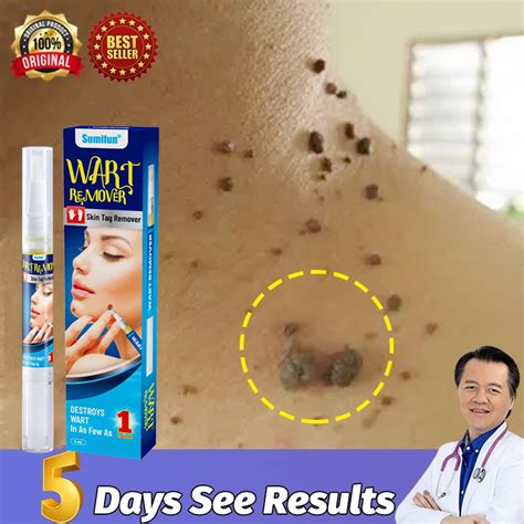 Diagram illustrating the application of a wart remover pen