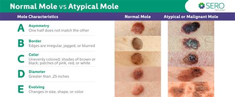 Image of a mole with uneven borders and varied colors, illustrating potential signs of melanoma.