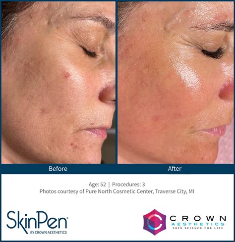 A collage of before-and-after photos showcasing diverse patients who have undergone SkinPen treatments, highlighting improved skin texture and radiance.