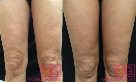 Before and after images of a thigh treated with Avéli, showing reduced dimpling.