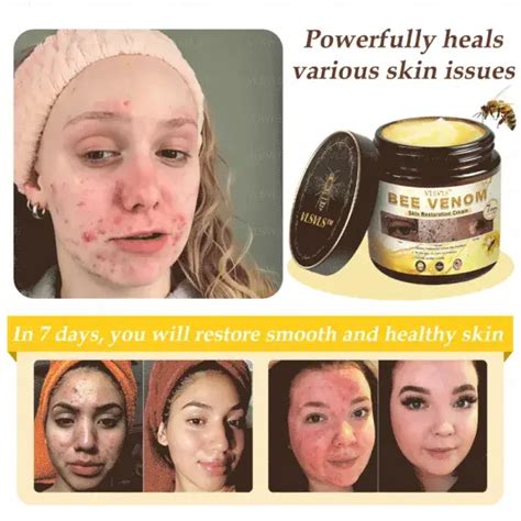 Before and after images showcasing the potential effects of bee venom cream on facial wrinkles and skin texture.