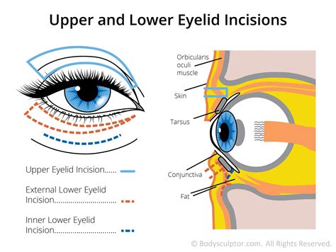 An illustration showing the anatomical layers of the eyelid and the typical incision points for upper and lower blepharoplasty.