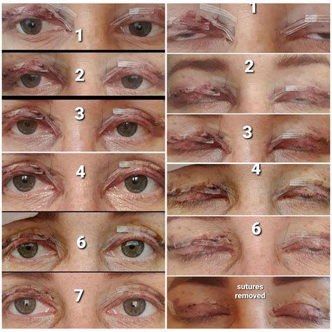A graphic illustrating the timeline of recovery after blepharoplasty, showing stages of swelling, bruising, and healing.