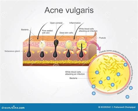 Illustration of acne vulgaris on skin