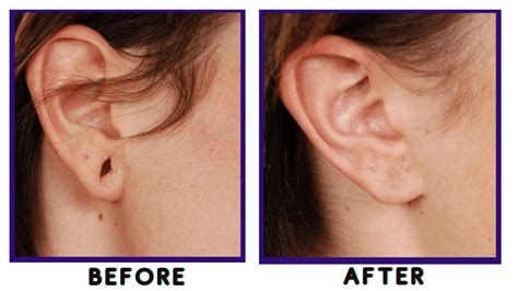 Before and after photos of ear lobe repair surgery.
