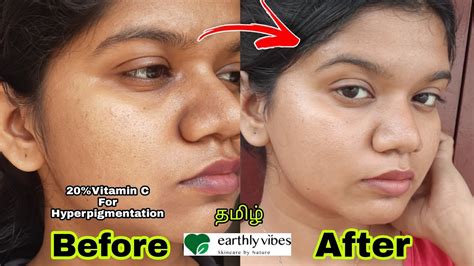 A split image showing before and after application of vitamin C for hyperpigmentation.