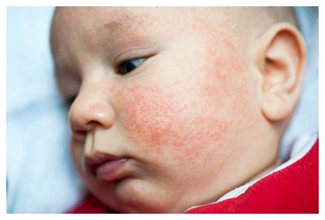A baby with mild eczema on their cheeks.