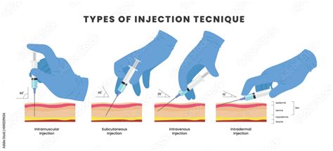 Visual representation of the micro-papule injection technique used for CH treatment.