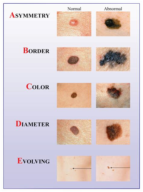 Illustration of the ABCDEs of melanoma with visual examples of asymmetry, irregular borders, varied colors, large diameter, and evolving changes.