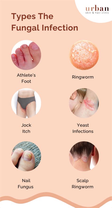 Infographic illustrating common fungal infections in babies and children, with visual examples of affected areas.