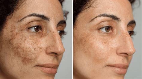 Before and after images showing improvement in hyperpigmentation and skin texture after using azelaic acid.