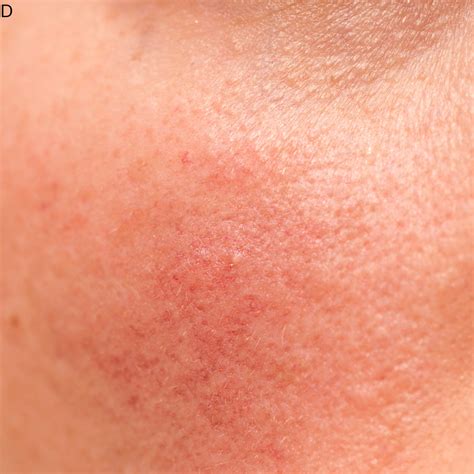 Close-up photograph of dry, irritated skin, illustrating the potential appearance of a damaged skin barrier.