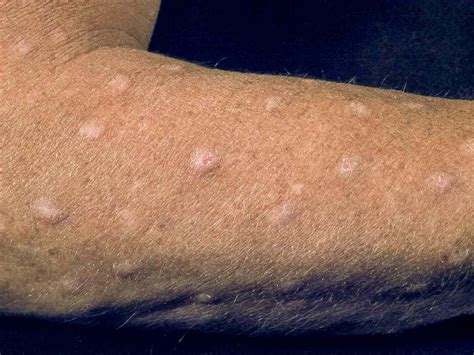 Image showing multiple firm, itchy bumps on the skin, characteristic of prurigo nodularis.