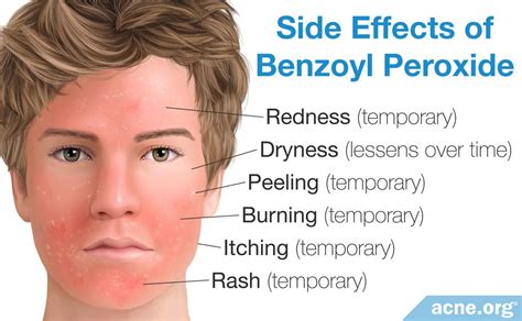 Infographic showing common side effects of benzoyl peroxide and how to manage them